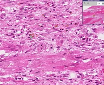 Myocardial Infarction - Recent