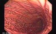 High resolution upper GI endoscopy video
