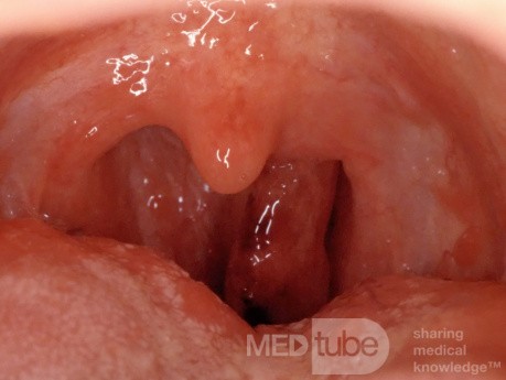 Retropalatal Choanal Polyp
