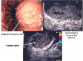 Post-traumatic "cavernoma" of the Pancreas