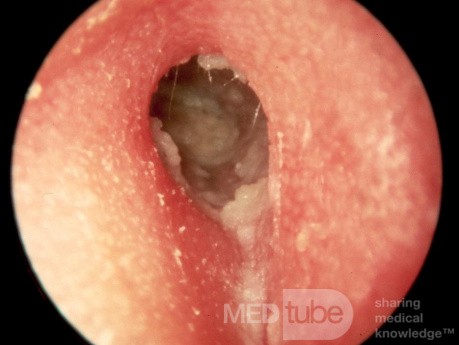 Chronic Hypertrophic Otitis Externa