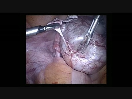 Laparoscopic Removal of Bilateral Ovarian Tumors