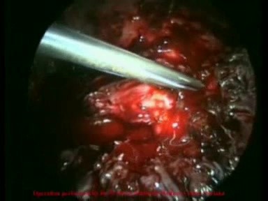 Excision of the Uterus