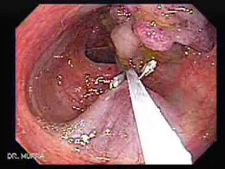 Colonoscopic Polypectomy (11 of 29)