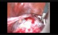 Laparoscopic Ovarian Endometriod Tumor
