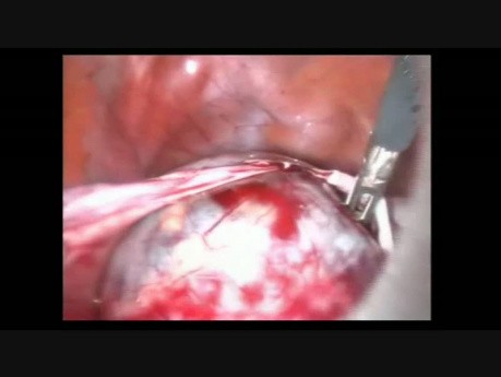 Laparoscopic Ovarian Endometriod Tumor