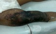 Sever degloving injury Rt. thigh