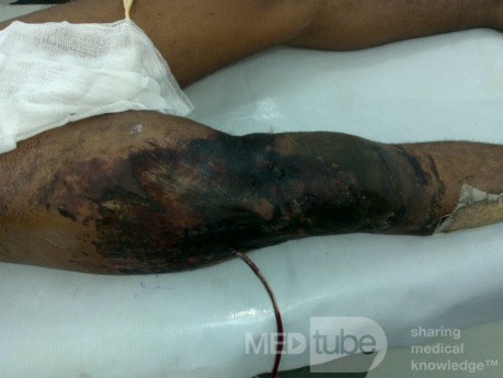 Sever degloving injury Rt. thigh