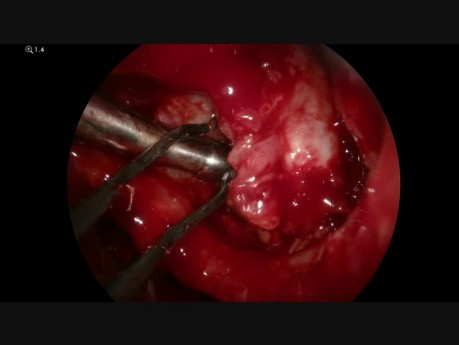 Sinus Tumor: Sarcoma in the Pterygopalatine Fossa (4K)