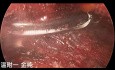 Dual-port Trans-subclavian Thyroid Endoscopic Surgery (part2)