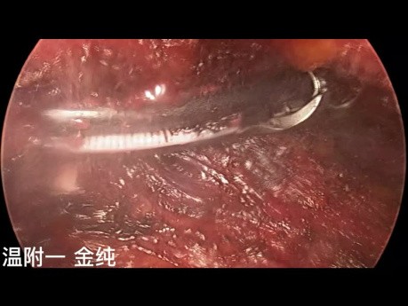 Dual-port Trans-subclavian Thyroid Endoscopic Surgery (part2)