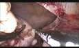 vNOTES Hysterectomy for Multiple Fibroid Uterus (ATRIUM Technique)