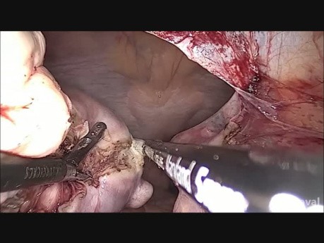 vNOTES Hysterectomy for Multiple Fibroid Uterus (ATRIUM Technique)