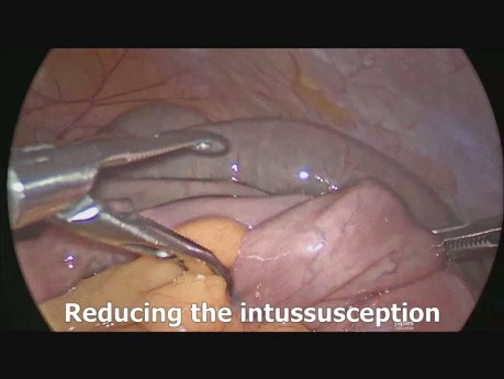 Laparoscopic Ileo-Ileal Untussusception Reduction and Resection of Ileal Lipoma