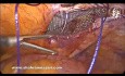 Laparoscopic Bilateral Inguinal Hernia Repair