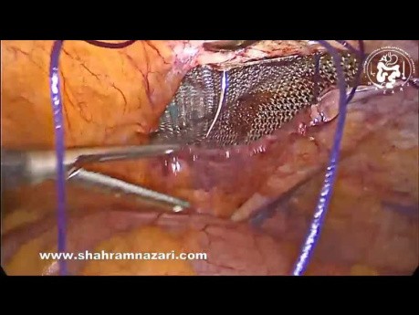 Laparoscopic Bilateral Inguinal Hernia Repair
