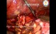 Laparoscopic Whipples Procedure