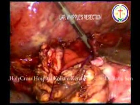 Laparoscopic Whipples Procedure
