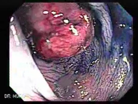 Colonoscopic Polypectomy (6 of 23)