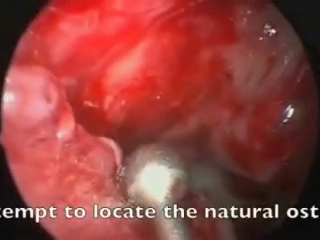 FESS After Caldwell-Luc Procedure