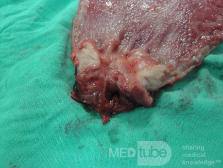 Gastric Ulcerated Adenocarcinoma of the Pre-pyloric Antrum (25 of 28)