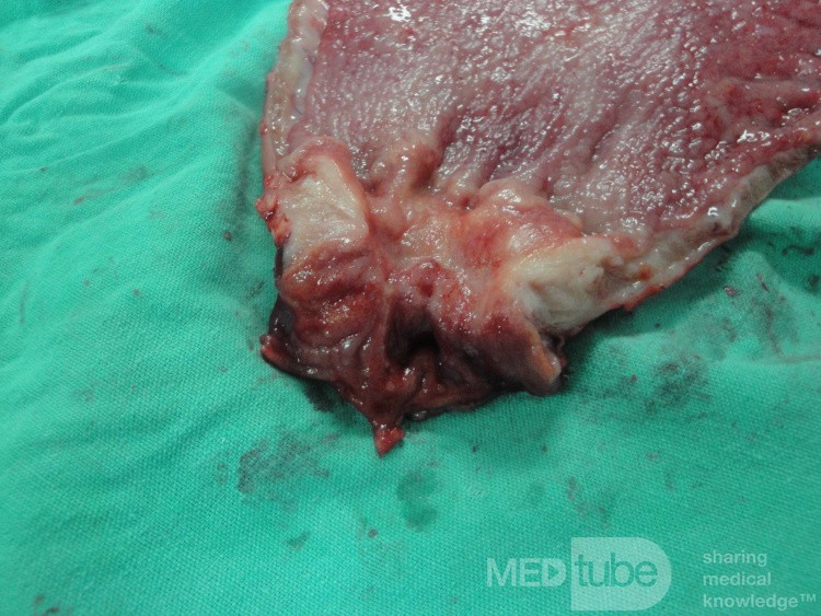Gastric Ulcerated Adenocarcinoma of the Pre-pyloric Antrum (25 of 28)
