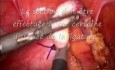 Laparoscopic Appendectomy 