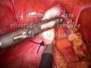 Laparoscopic Appendectomy 