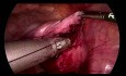 SELS - Laparoscopic Myomectomy