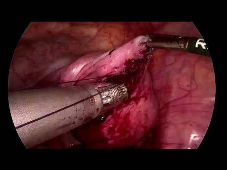 SELS - Laparoscopic Myomectomy
