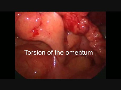 Laparoscopic Management of Omental Torsion