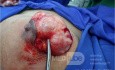 Breast Giant Fibroadenoma 