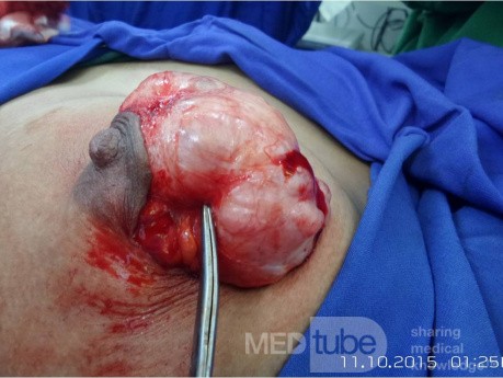 Breast Giant Fibroadenoma 