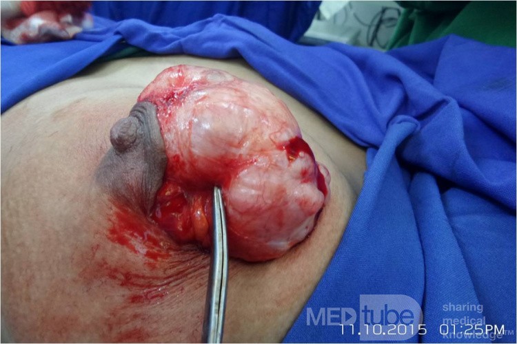 Breast Giant Fibroadenoma 
