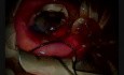 Expulsice Haemorrhage During Penetrating Keratoplasty