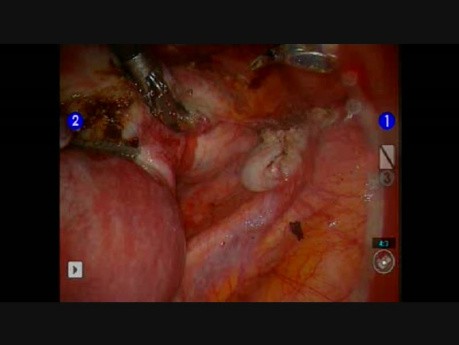 20 Week Supracervical Hysterectomy Robotically