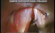 Fibrous vocal fold nodules excision