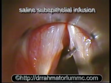 Fibrous vocal fold nodules excision
