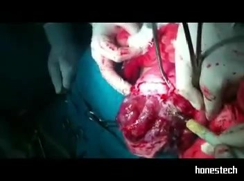 Excision of Leiomyomas - 35 Years Old Virgin