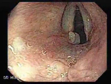 Laryngopharyngeal reflux (LPR)