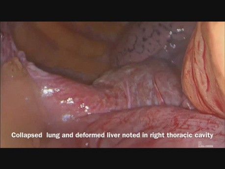 Laparoscopic Repair of Traumatic Giant Right Diaphragmatic Hernia