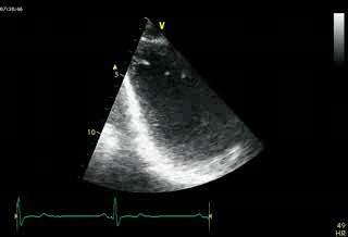 2 Chambers  Normal Study (Apical View)