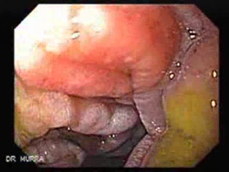 Gastroduodenal MALT lymphoma (5 of 9)