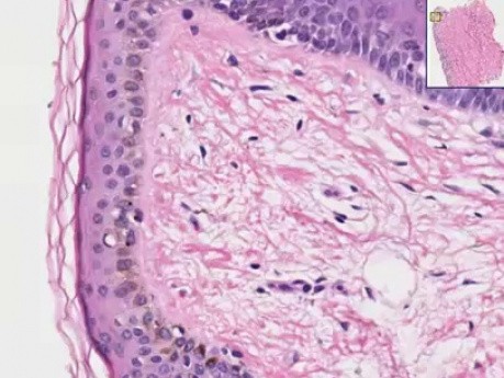 Lentigo - Histopathology of skin