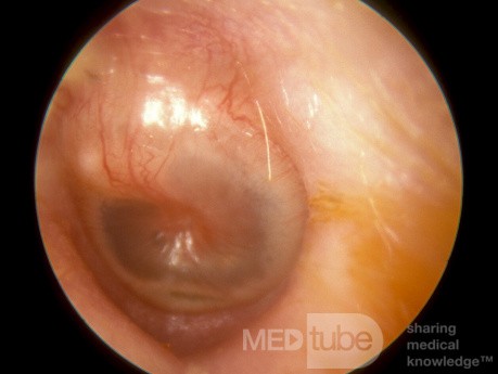 Early Acute Otitis Media
