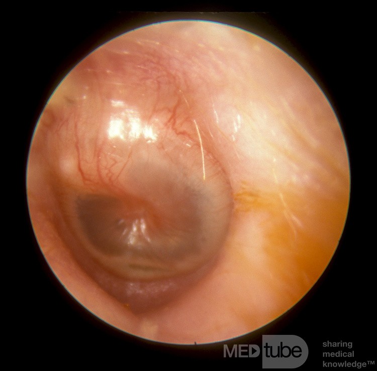 Early Acute Otitis Media