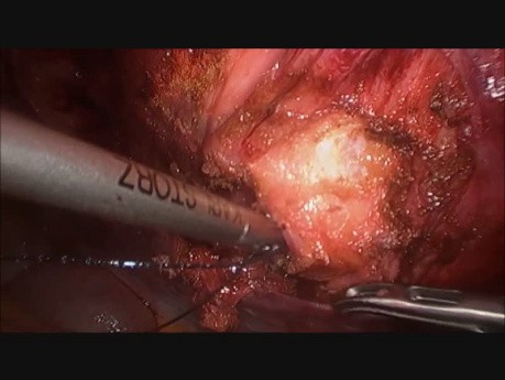 TAPP or TARM - Transabdominal Preperitoneal Retromuscular Incisional Hernia Repair