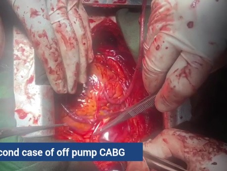Off Pump CABG Concomitant Another Organ Malignancy and Intra Operative Fibrillation Without Converting to on Pump CABG 