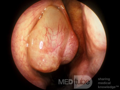 Nasal Polyp