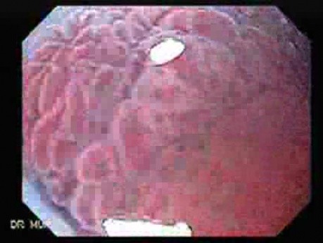 Multiple Gastric Ulcers - Endoscopy (7 of 10)